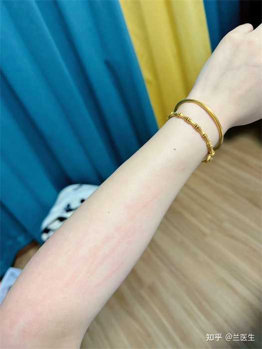 荨麻疹的根治之路，科学治疗与综合管理策略荨麻疹怎么治疗能除根知乎